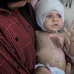 gazzede vucudu yanan 1 yasindaki muhammed yardim bekliyor A8KIn8q9